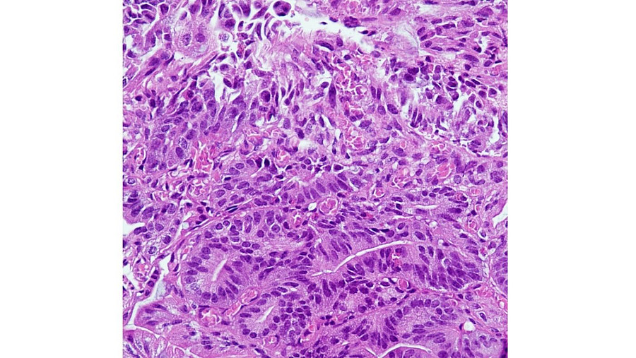 Histopathologische Aufnahmen von Tumorzellen sind ein zentraler Bestandteil der Krebsdiagnostik. Quelle: S. Försch